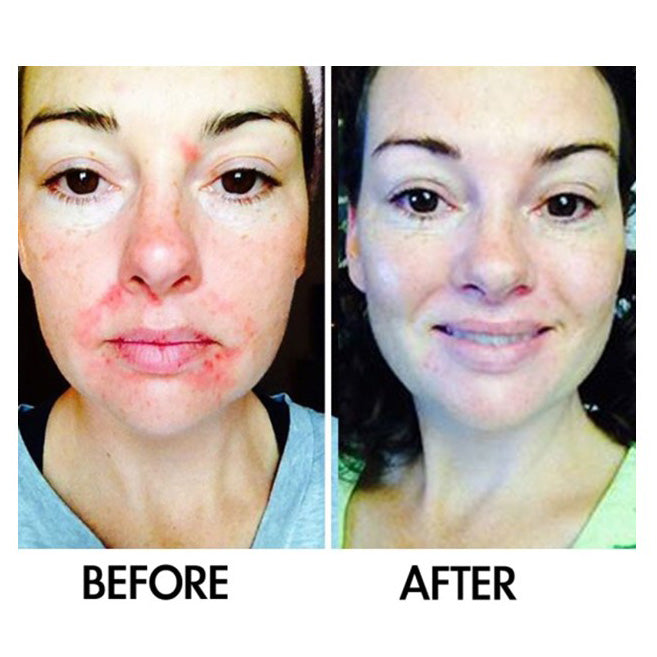 SkinSanity® Acne Treatment - Clear Skin Results Regimen