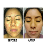 SkinSanity® Dual Acne Serum – All-Natural 1 fl oz
