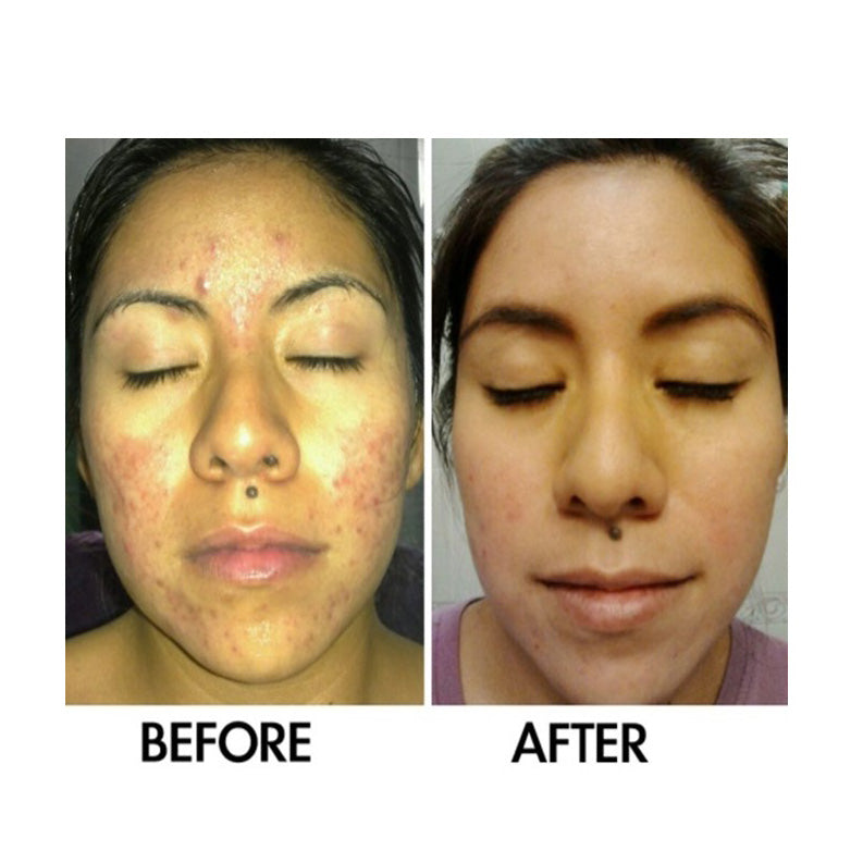 SkinSanity® Acne Treatment - Clear Skin Results Regimen